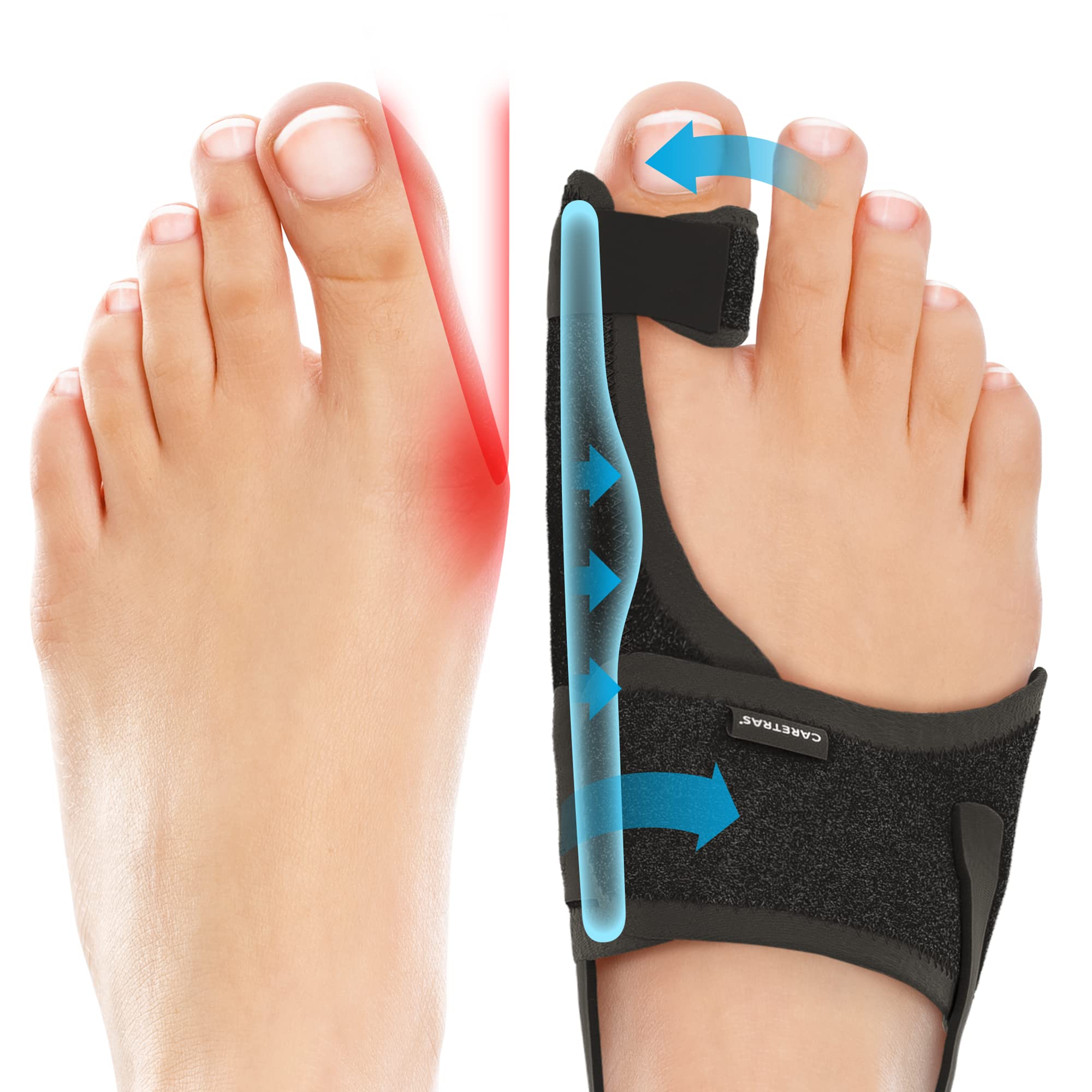 Bunion Correctors