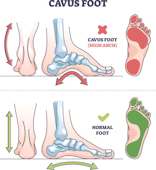 Insoles for High Arches